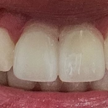 Premier Family Dental Care - Completely miss colored, Swanson even took a photo with the flash on from a 45 degree angle to pretend they weren't incorrectly colored. - General Dentistry Near Me - Gilbert, Arizona Premier Family Dental Care - Completely miss colored, Swanson even took a photo with the flash on from a 45 degree angle to pretend they weren't incorrectly colored. - General Dentistry Near Me - Gilbert, Arizona