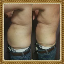 Anti Aging Center of Boca - He lost over 6" in just one session