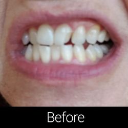 Friendly Dental Care - Before they put temporary bond