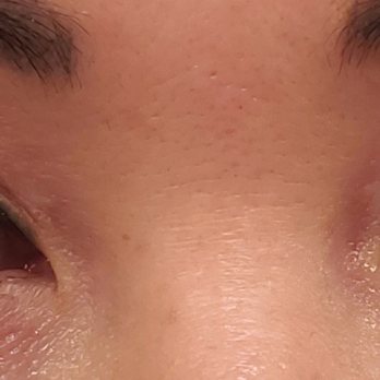 Adam J Cohen, MD - My perfect eyelids 1 month before surgery with Dr. Cohen. - Cosmetic Surgeons Near Me - Glenview, Illinois Adam J Cohen, MD - My perfect eyelids 1 month before surgery with Dr. Cohen. - Cosmetic Surgeons Near Me - Glenview, Illinois