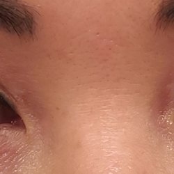 Adam J Cohen, MD - My perfect eyelids 1 month before surgery with Dr. Cohen.