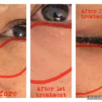 Deanna Damasen, DAcCHM - microneedling for millia is beneficial - Acupuncture Near Me - Benicia, California Deanna Damasen, DAcCHM - microneedling for millia is beneficial - Acupuncture Near Me - Benicia, California