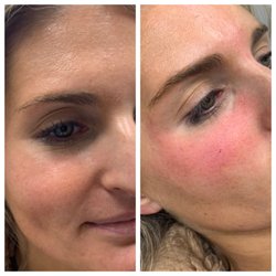 Kurtis Martin, MD - Cincinnati Plastic Surgery - Obsessed with the results!!