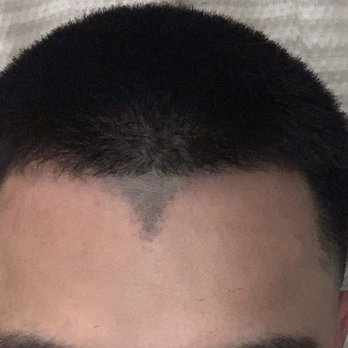 SEV Laser - The work speaks for itself. I came in for a widows peak removal & this is the result after the first treatment. - Laser Hair Removal Near Me - Burlingame, California