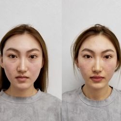 Jonathan Brock, MD - Tear trough under eye treatment