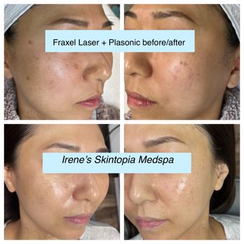 Irene's Skintopia - Fraxel laser and plasonic facials - Skin Care Near Me - Los Angeles, California Irene's Skintopia - Fraxel laser and plasonic facials - Skin Care Near Me - Los Angeles, California