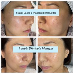 Irene's Skintopia - Fraxel laser and plasonic facials