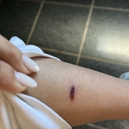 My leg burned after one week