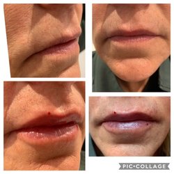The Beautx Laser & Skin Care - Got thin lips? No problem