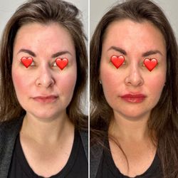 Gorgeous natural lip filler results
