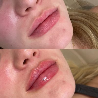 Fillers! - Fillers! Juvederm, Restylane, RHA, Versa! Fillers! - Fillers! Juvederm, Restylane, RHA, Versa!
