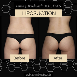 Liposuction results by board certified plastic surgeon, Dr. David Boudreault