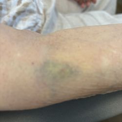 Quest Diagnostics - Hematoma