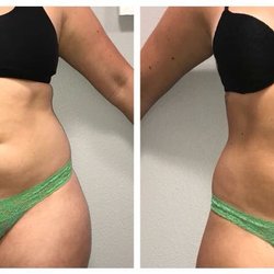 Skin Solutions by Lani - SCULPT - body contouring detox