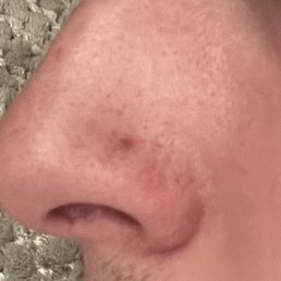 Nose piercing that had improper sized/low quality jewelry Nose piercing that had improper sized/low quality jewelry