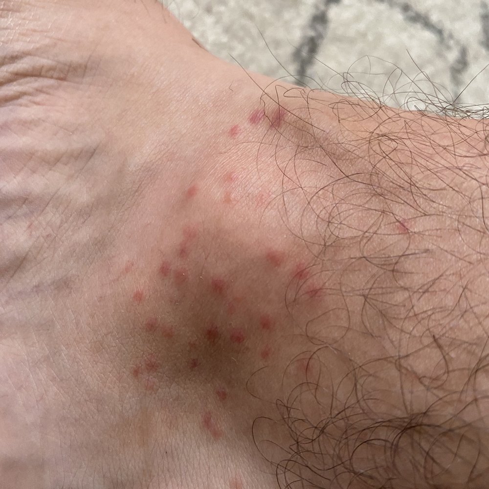 Riverview Restaurant - Mosquito bites - New American Near Me - Cold Spring, New York Riverview Restaurant - Mosquito bites - New American Near Me - Cold Spring, New York