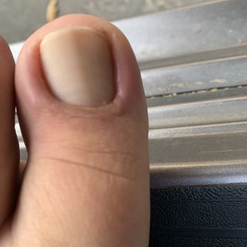 Harbour Nails & Spa - Big toe with ingrowns on both sides thanks to Mimi. You can see the swelling even tough I've drained the pus already. - Nail Salons Near Me - Elk Grove, California Harbour Nails & Spa - Big toe with ingrowns on both sides thanks to Mimi. You can see the swelling even tough I've drained the pus already. - Nail Salons Near Me - Elk Grove, California