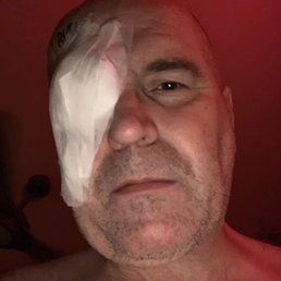 After emergency surgery of nearly losing an eye after my Retina decided to detach itself from my eyeball. After emergency surgery of nearly losing an eye after my Retina decided to detach itself from my eyeball.