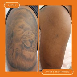 Delete Tattoo Removal and Medical Salon