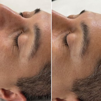 Morgan Hill Skin Care - Before & After- 1 series of Jet Plasma - Estheticians Near Me Morgan Hill Skin Care - Before & After- 1 series of Jet Plasma - Estheticians Near Me