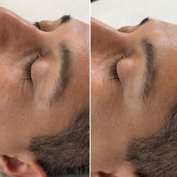 Morgan Hill Skin Care - Before & After- 1 series of Jet Plasma