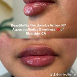 Lip filler is $450 for a limited time