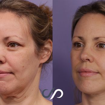 Stoker Plastic Surgery - Angled view of face, neck and eyelid lift - Cosmetic Surgeons Near Me - Marina Del Rey, California Stoker Plastic Surgery - Angled view of face, neck and eyelid lift - Cosmetic Surgeons Near Me - Marina Del Rey, California