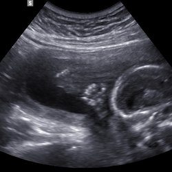 Home Baby Reveal - 2D - Baby's Hands
