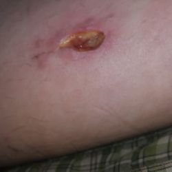 Dr Robert Kistner - This is the results of this doctors stitching job. I am filing a complaint with the state medical board.