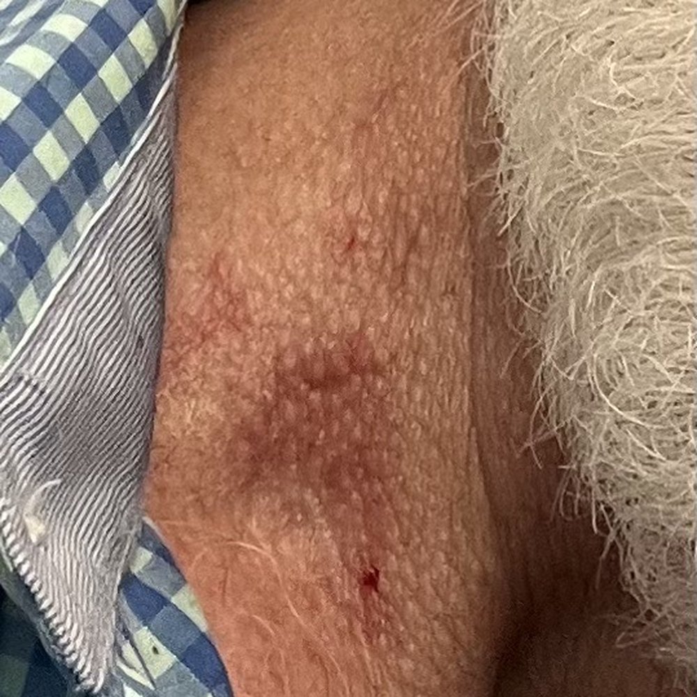 It hurts. They cut me with electric clippers. Yikes! It looks like a hickey. It hurts. They cut me with electric clippers. Yikes! It looks like a hickey.