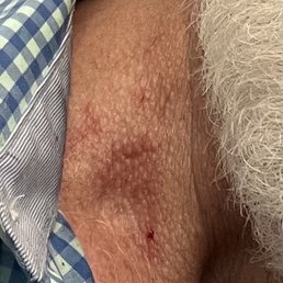 It hurts. They cut me with electric clippers. Yikes! It looks like a hickey. It hurts. They cut me with electric clippers. Yikes! It looks like a hickey.