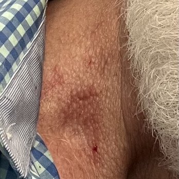 Lansdowne Barber Shop - It hurts. They cut me with electric clippers. Yikes! It looks like a hickey. - Barbers Near Me - Leesburg, Virginia Lansdowne Barber Shop - It hurts. They cut me with electric clippers. Yikes! It looks like a hickey. - Barbers Near Me - Leesburg, Virginia