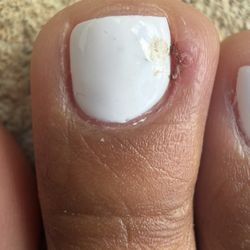 Lush Nail Bar - Cut toe from pedicure