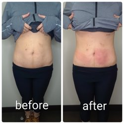 VitaVida Beauty - Cryoskin Slimming treatments freeze fat cells in target areas and allow the body's natural processes to flush the dead cells out permanently