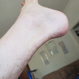 My busted Achilles tendon four and a half months after surgery. My busted Achilles tendon four and a half months after surgery.