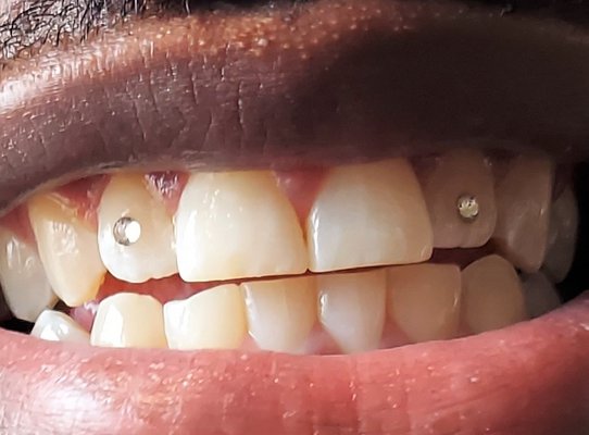 Tooth Gem (Jewelry) Swarovski & Basic - Using the same application process that Dentists use to apply braces, All Smiles On Me uses carefully placed authentic Swarovski crystals to give your smile a little extra shine! - Swarovski
Tooth Gem (Jewelry) - Basic Tooth Gem (Jewelry) Swarovski & Basic - Using the same application process that Dentists use to apply braces, All Smiles On Me uses carefully placed authentic Swarovski crystals to give your smile a little extra shine! - Swarovski
Tooth Gem (Jewelry) - Basic