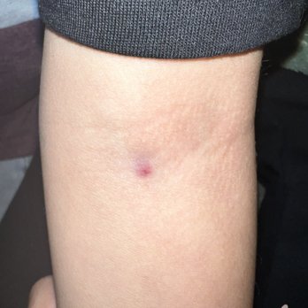 Quest Diagnostics - Arm she pricked twice - Laboratory Testing Near Me - Fontana, California Quest Diagnostics - Arm she pricked twice - Laboratory Testing Near Me - Fontana, California