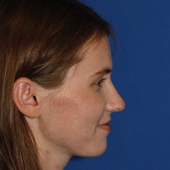 Lamperti Facial Plastic Surgery Cosmetic Surgeons 1101 Madison St First Hill Seattle Wa Phone Number Yelp