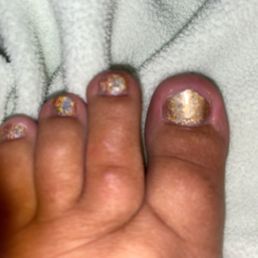 Toenail that ripped a few days after pedicure