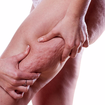 My Exscape and More - Stubborn cellulite..Book your FREE Lypossage consultation now!! - Massage Near Me - Raleigh, North Carolina My Exscape and More - Stubborn cellulite..Book your FREE Lypossage consultation now!! - Massage Near Me - Raleigh, North Carolina