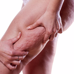 My Exscape and More - Stubborn cellulite..Book your FREE Lypossage consultation now!!