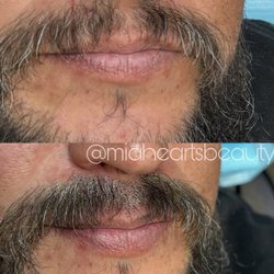 Micropigmentation to fill in gaps