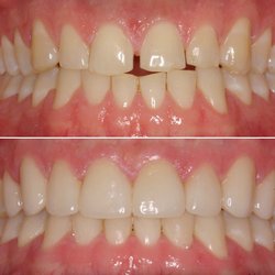 Rose Cosmetic & Family Dentistry - Cosmetic makeover with the use of porcelain veneers.