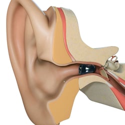 ClearLife Hearing Care - ClearLife Hearing Care offers invisible in the canal hearing aids for people who need hearing aids but don't want them to be seen.