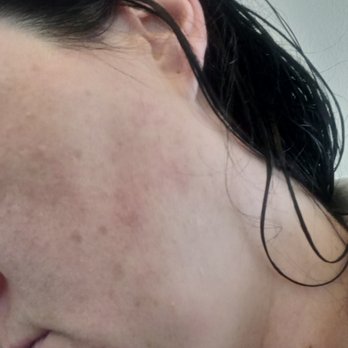 LaserAway - Laser Hair Removal Near Me - Novato, California LaserAway - Laser Hair Removal Near Me - Novato, California