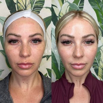 Enve California Aesthetics - Microneedling with Exosomes by RN Taylor - Medical Spas Near Me - Tustin, California Enve California Aesthetics - Microneedling with Exosomes by RN Taylor - Medical Spas Near Me - Tustin, California