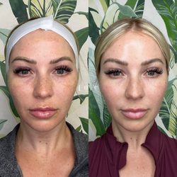 Enve California Aesthetics - Microneedling with Exosomes by RN Taylor