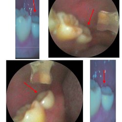New Life Dental Implant Center - Implant much smaller & lower than molar it is supposed to replace.  Dr. Mark Haley refused to fix it.  Dr. was not even there most times.
