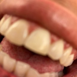 The front tooth on the right The front tooth on the right