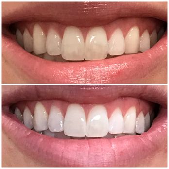 Sudden Gleam - Teeth Whitening Near Me - Gilbert, Arizona Sudden Gleam - Teeth Whitening Near Me - Gilbert, Arizona